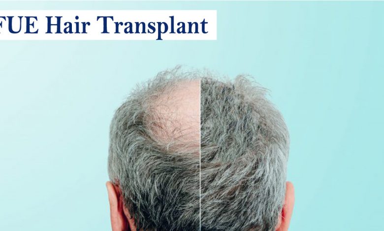 fue hair transplant- Procedure & Results and Side Effects Of FUE Hair Transplant