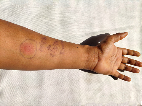 tuberculosis skin test