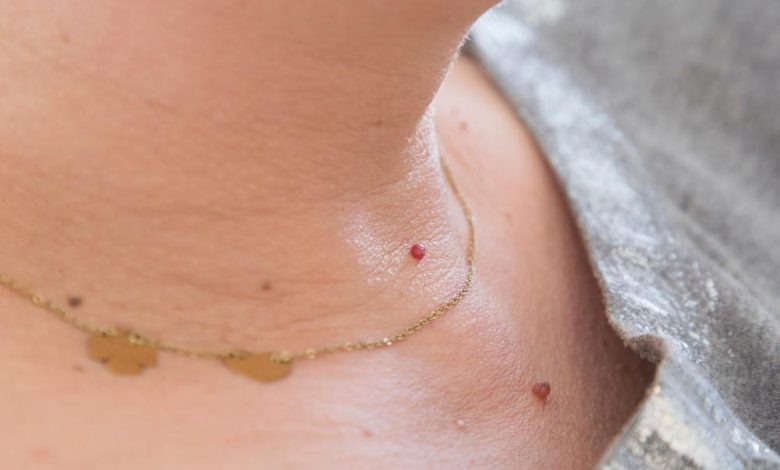 skin tag removal treatment